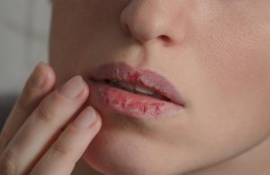 Sausos ir suskilinėjusios lūpos: kokias klaidas kartojame kiekvieną žiemą?