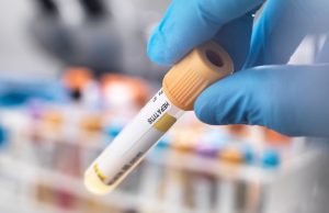 Airijoje pas kelis vaikus aptikta paslaptinga hepatito viruso atmaina